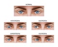 Different types of strabismus. Royalty Free Stock Photo